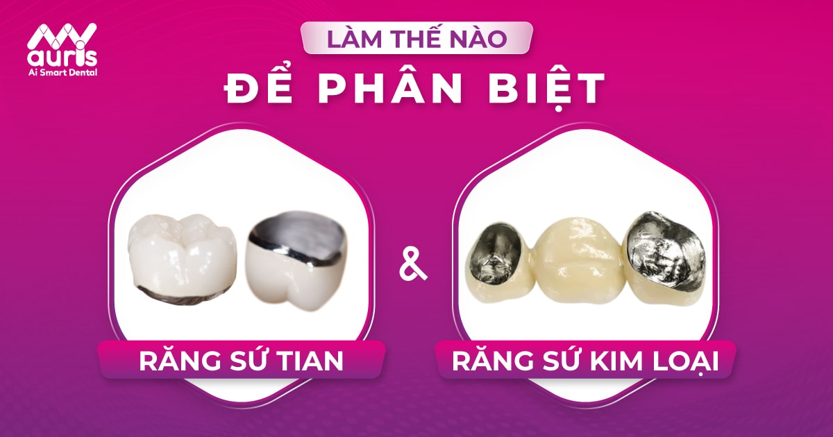 phân biệt răng sứ titan và răng sứ kim loại