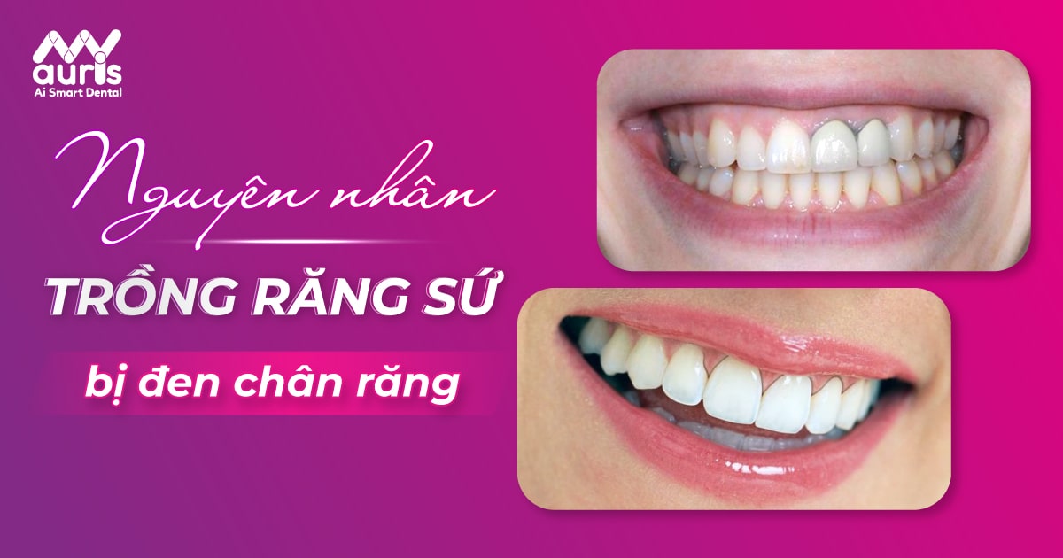 trồng răng sứ bị đen chân răng