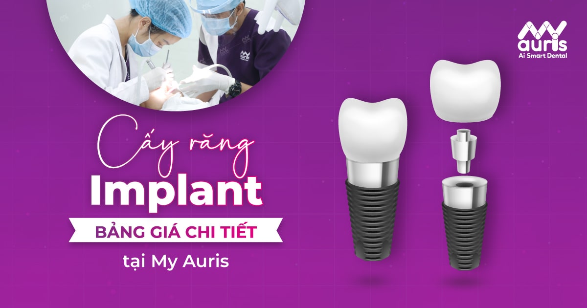 Bảng giá cấy răng Implant chi tiết tại My Auris