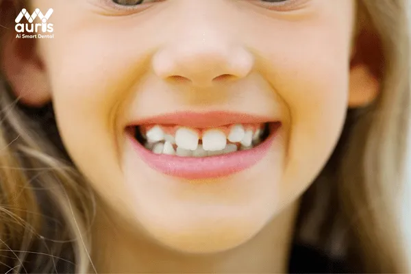 Răng thưa là răng gì?