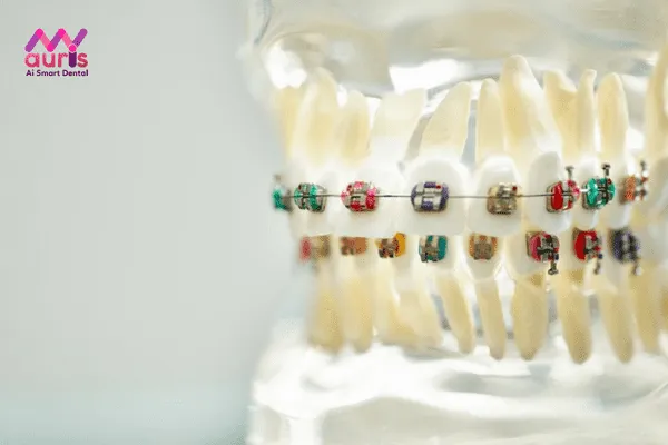 Bảng giá niềng răng thưa ở phương pháp niềng răng truyền thống