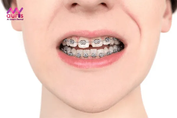 Hậu quả răng thưa có thể mang lại cho bạn?
