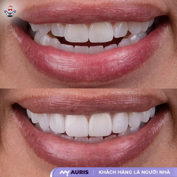 bọc răng sứ venus,có nên bọc răng sứ venus