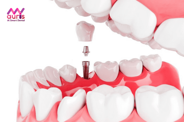 Tìm hiểu thông tin phương pháp trồng răng Implant