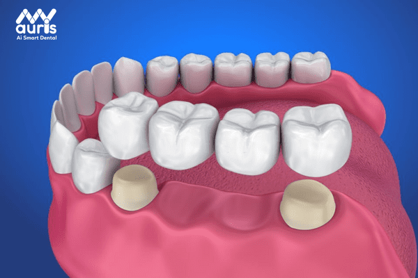 Trồng răng cấm bằng phương pháp bắc cầu răng sứ