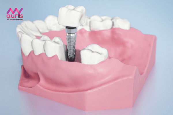 Trồng răng cấm bằng Implant là cách thay thế tốt nhất