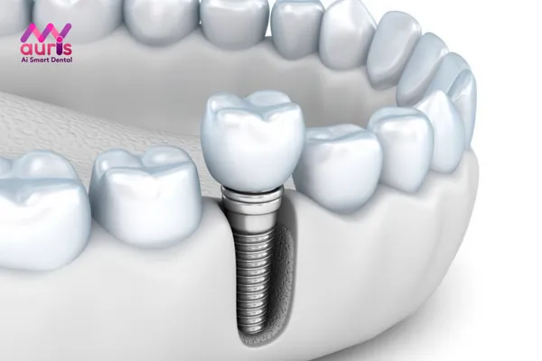 Chi phí trồng răng cấm bằng phương pháp cấy ghép Implant
