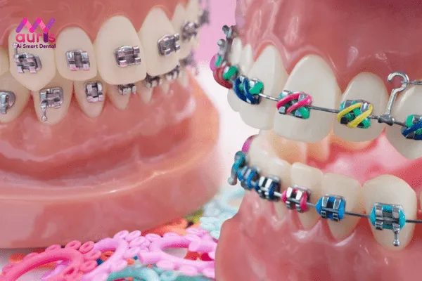 Niềng răng mắc cài kim loại có đau không và cách khắc phục