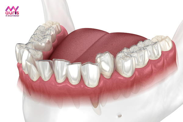 có nên niềng răng trong suốt không