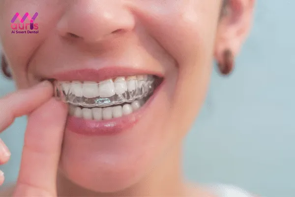 Niềng răng trong suốt 1 hàm là phương pháp gì?
