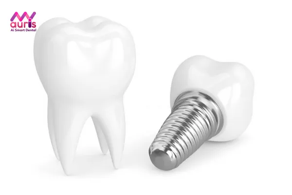 Trông răng cấm giả bằng phương pháp cấy răng Implant