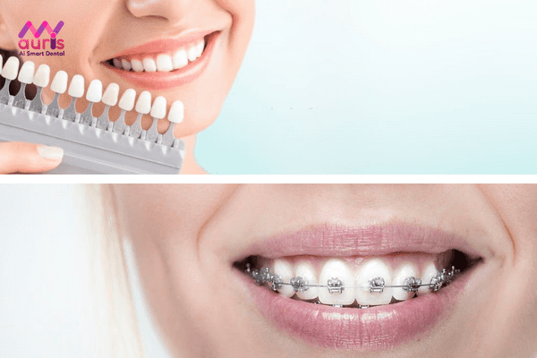 Thực hiện bọc răng sứ hay niềng răng cho tình trạng răng thưa