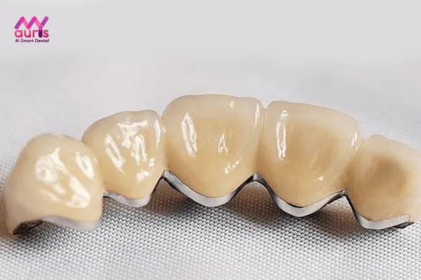 Bọc răng sứ titan có bị đen không?