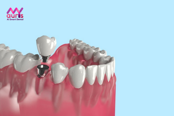 Tìm hiểu phương pháp trồng răng Implant