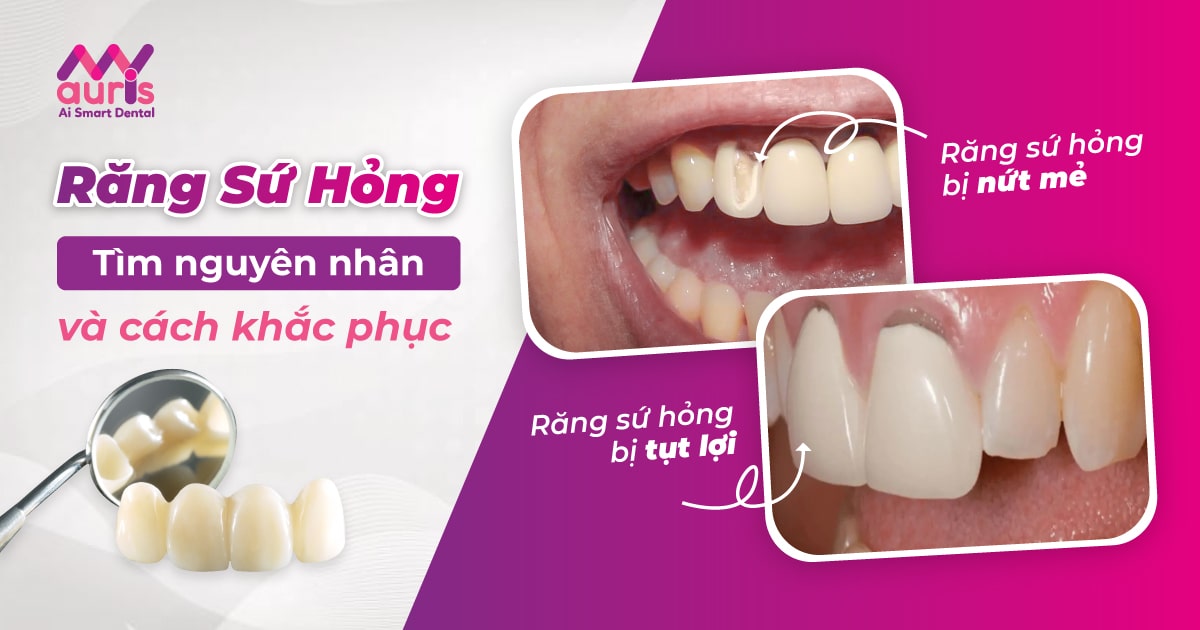 Nguyên nhân gây răng sứ hỏng và cách khắc phục