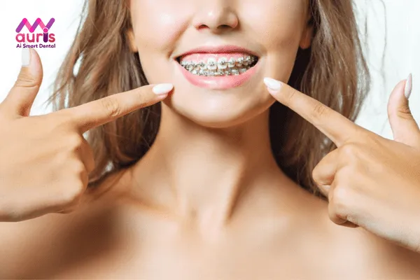 Lý do bạn nên sử dụng niềng răng mắc cài kim loại thường