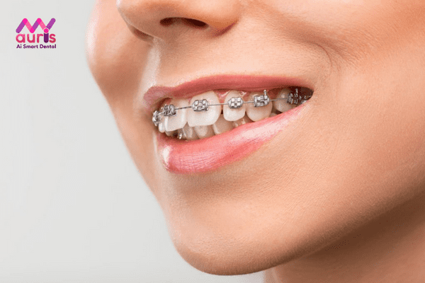 Tìm hiểu phương pháp niềng răng mắc cài kim loại truyền thống