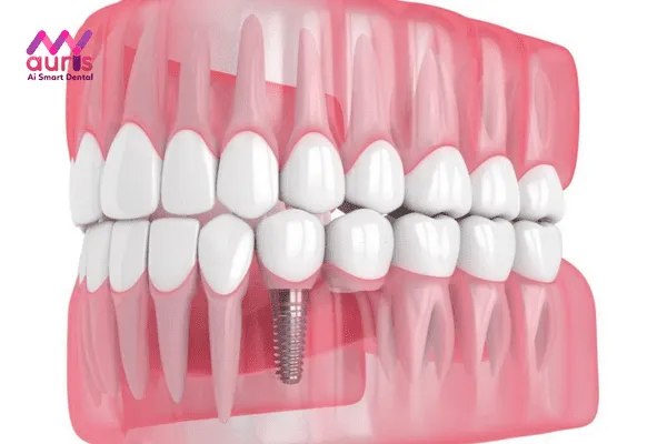 Trồng răng hàm Implant là phương pháp gì?