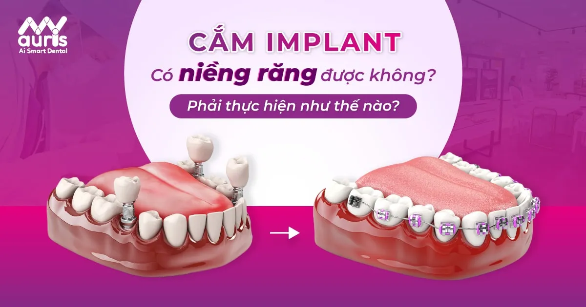 cắm implant có niềng răng được không