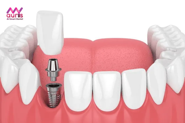 Bảng giá trồng răng cửa bằng Implant