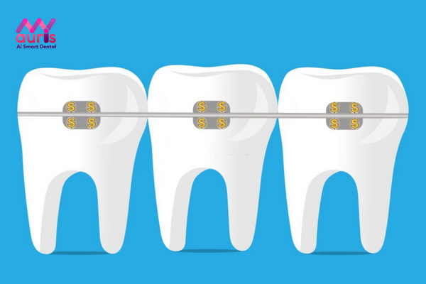 Tìm hiểu thông tin về chi phí niềng răng mắc cài tự buộc