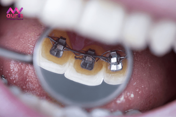 Niềng răng mắc cài kim loại mặt trong là phương pháp gì?