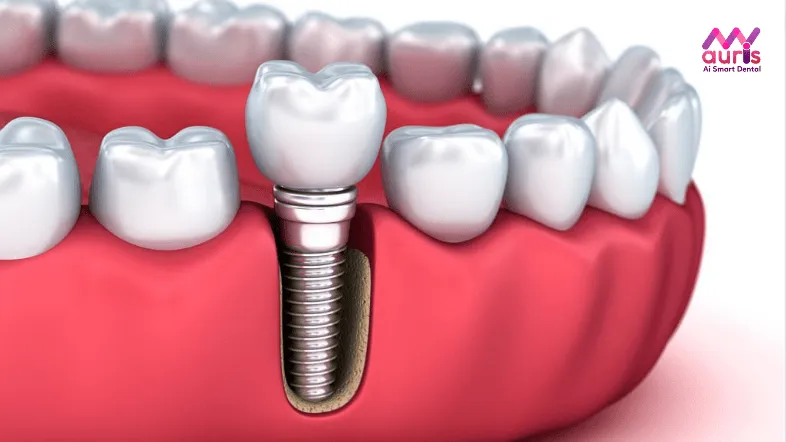 tổng chi phí trồng răng implant