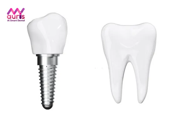 Trồng răng khểnh cho nam bằng trồng răng Implant