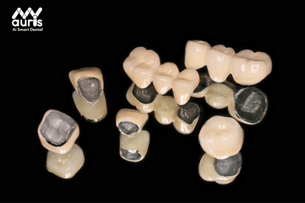 ưu nhược điểm của răng sứ titan
