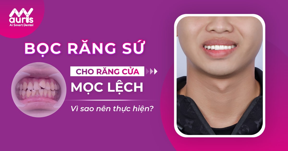 bọc răng sứ cho răng cửa mọc lệch