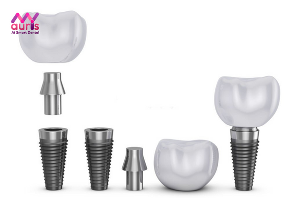 Chi phí trồng răng sứ với phương pháp trồng răng Implant