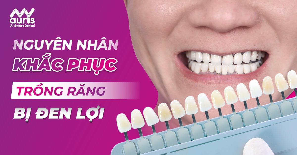 trồng răng bị đen lợi