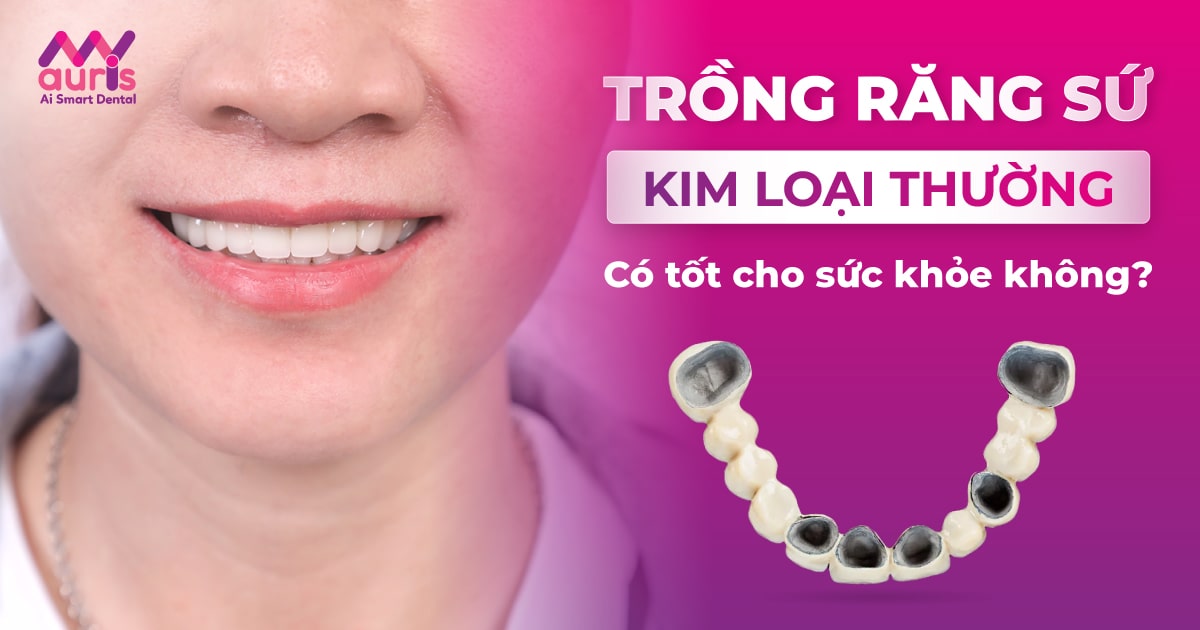 giá răng sứ kim loại thường