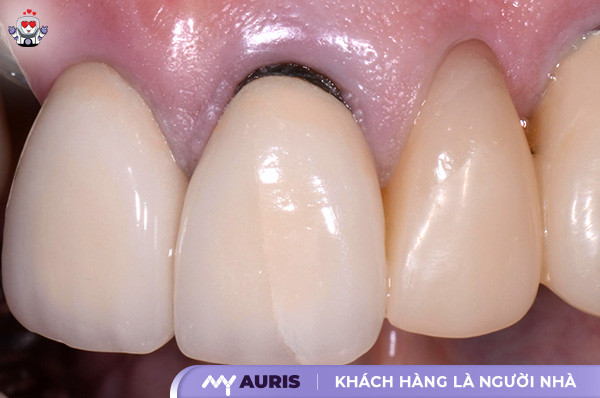 cách bảo quản răng sứ titan
