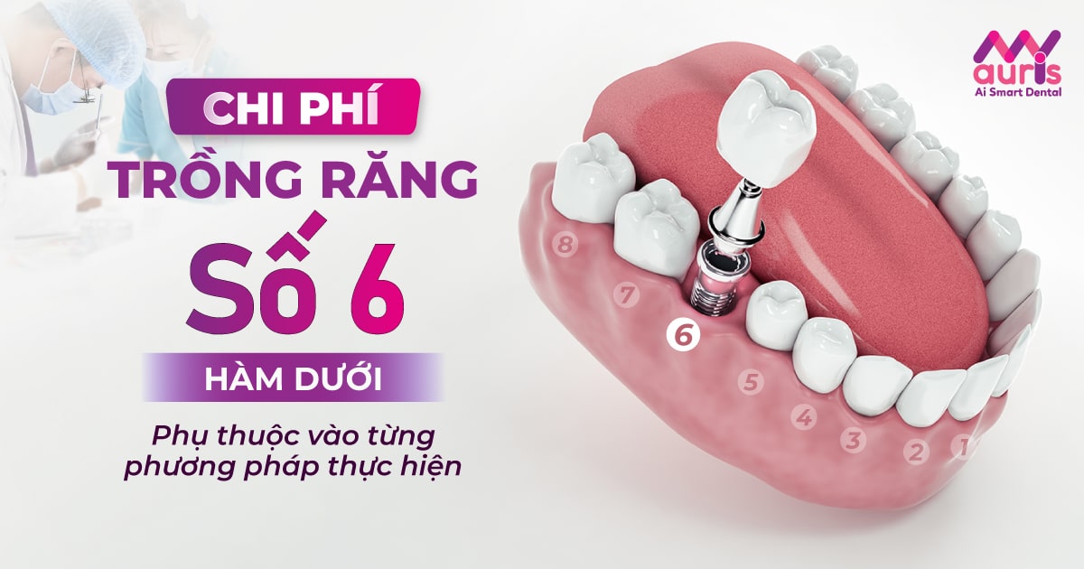 Chi phí trồng răng số 6 hàm dưới