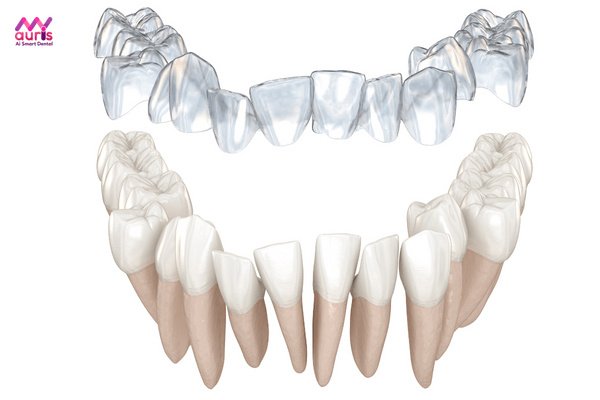 bộ niềng răng trong suốt tại nhà 