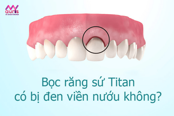  răng sứ titan có làm đen viền nướu