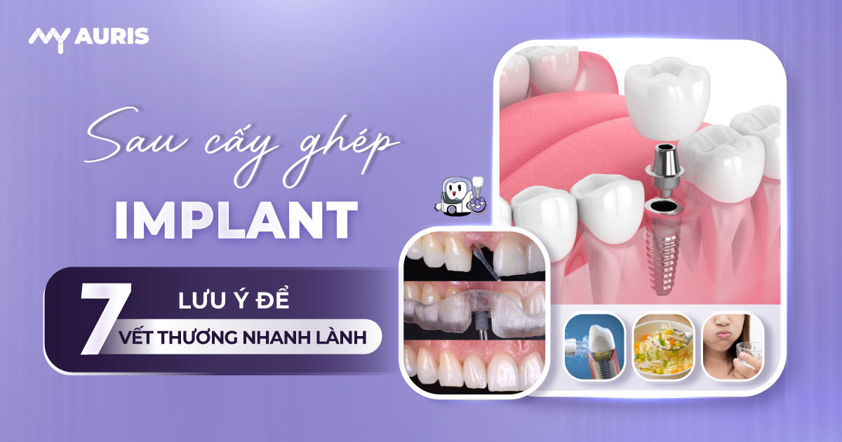lưu ý sau khi cấy ghép implant,lưu ý khi trồng răng implant,sau cấy ghép implant