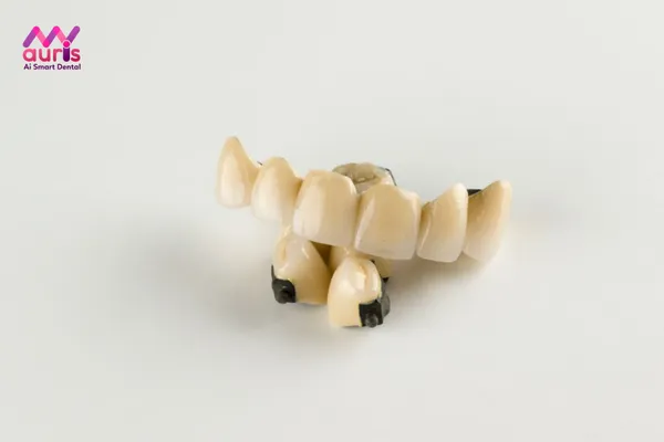 Răng sứ kim loại là răng gì?