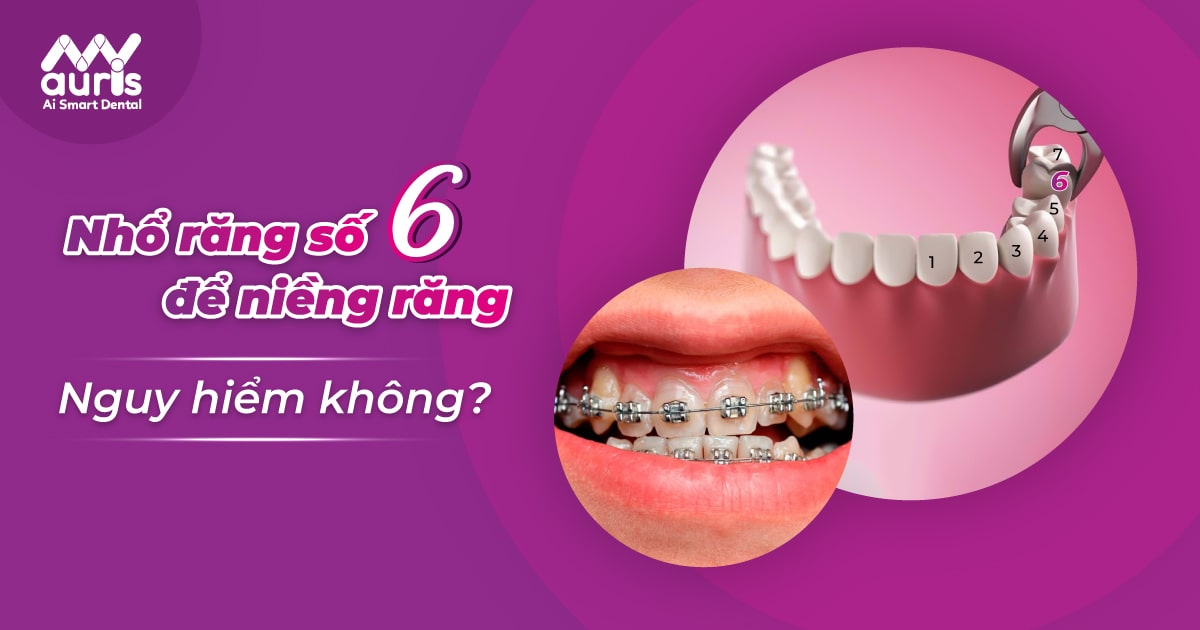 nhổ răng số 6 để niềng răng