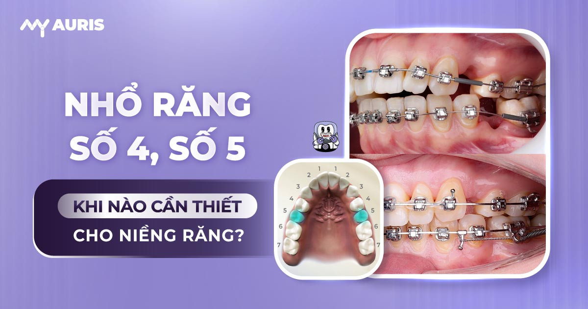 niềng răng nhổ răng số 5