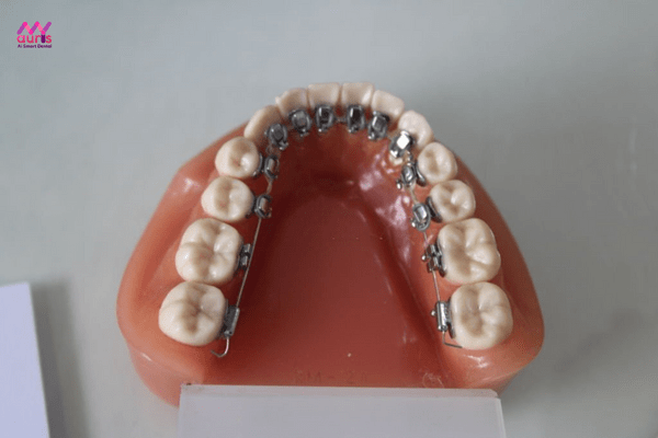  phương pháp niềng răng mắc cài mặt trong 