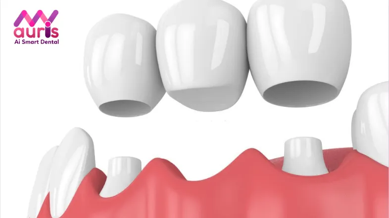 quy trình làm cầu răng sứ