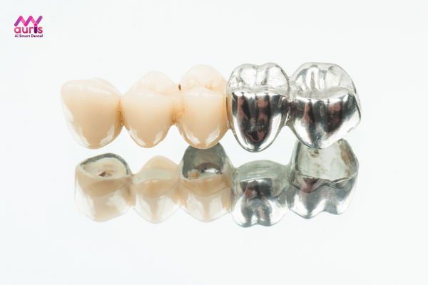 bảng giá răng sứ kim loại