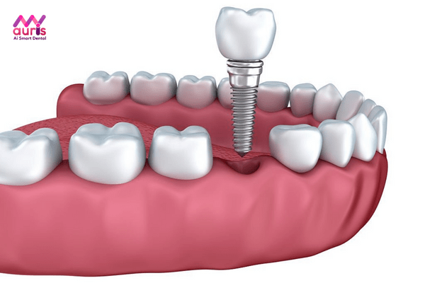 trồng răng implant được bao lâu