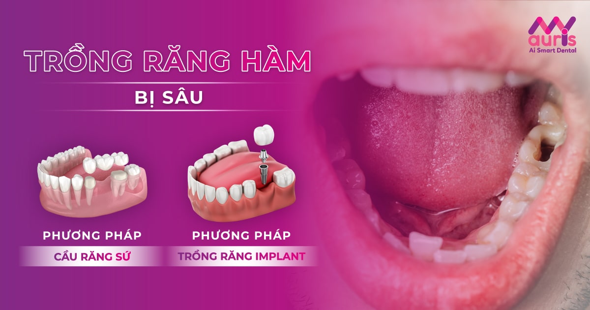 2 phương pháp trồng răng hàm bị sâu bạn nên biết