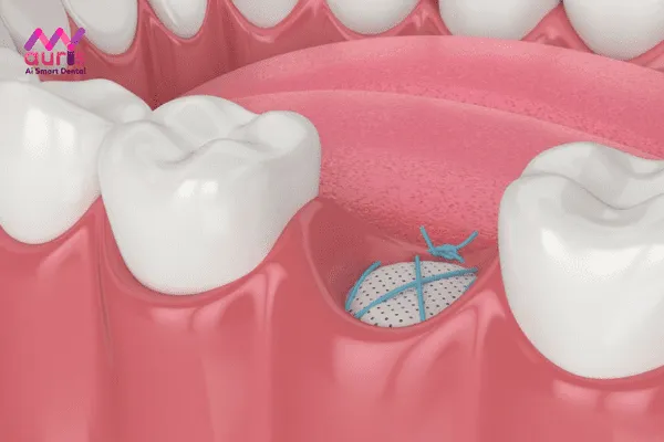 Thực hiện cấy ghép xương trồng lại răng Implant mới