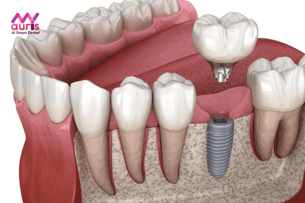 Trồng răng Implant có gây nguy hiểm gì không?
