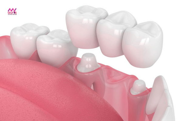  tác hại trồng răng sứ
