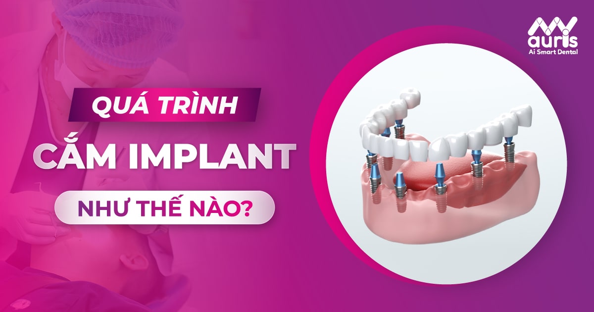 quá trình cắm implant